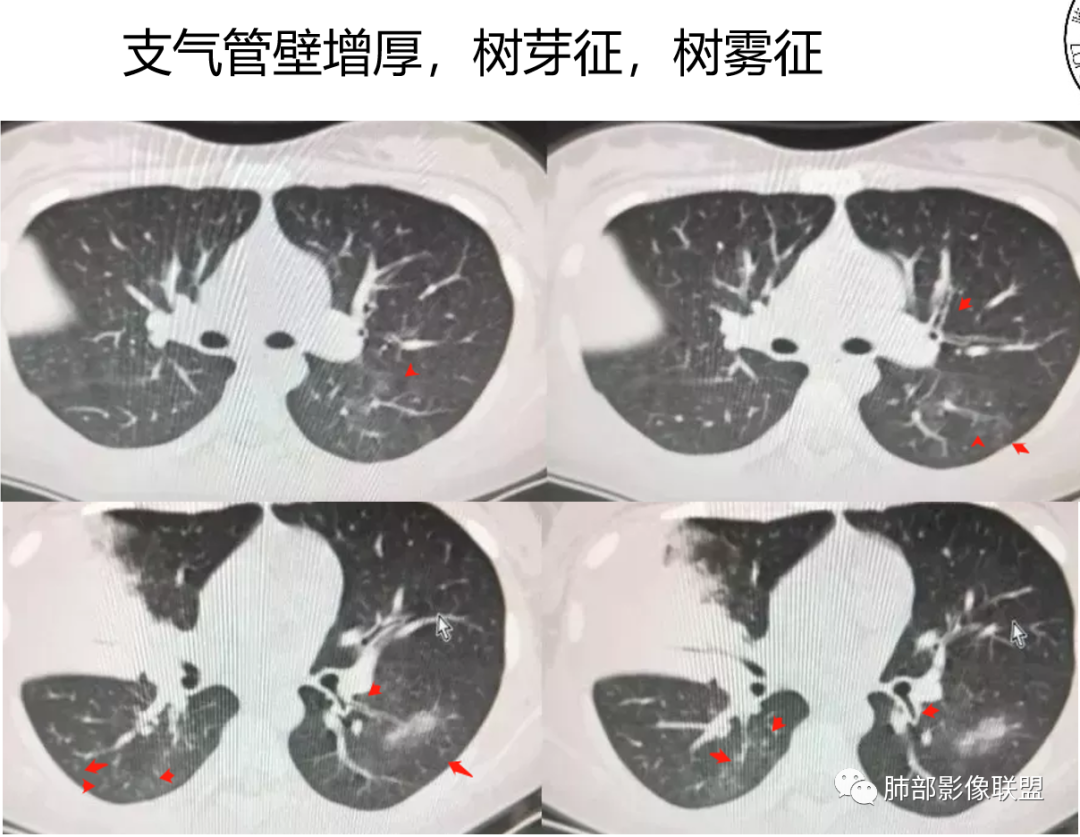 影像PPT - 【病例】支原体肺炎与肺结核的鉴别-35 影像PPT - 【病例】支原体肺炎与肺结核的鉴别-35
