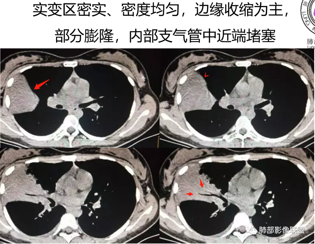 影像PPT - 【病例】支原体肺炎与肺结核的鉴别-34 影像PPT - 【病例】支原体肺炎与肺结核的鉴别-34