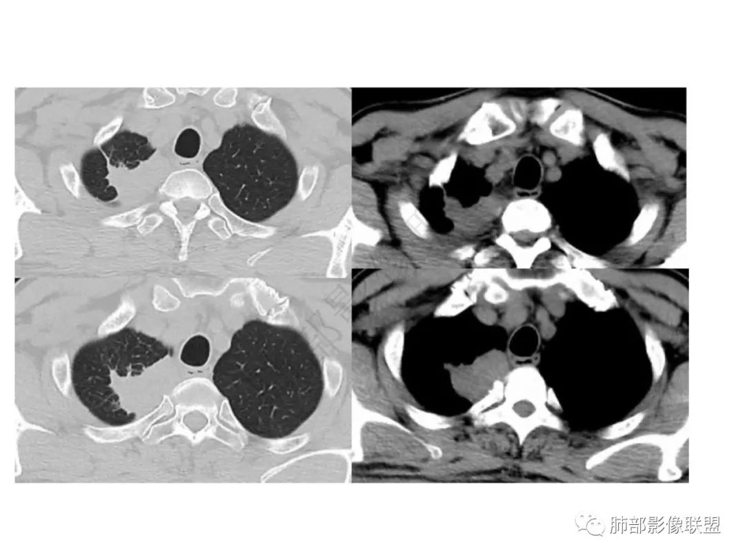 影像PPT - 【病例】肺放线菌病一例CT-5 影像PPT - 【病例】肺放线菌病一例CT-5