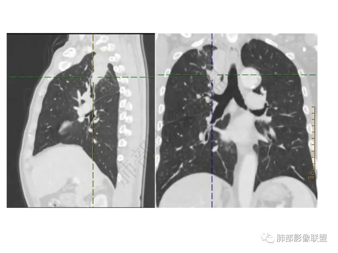 影像PPT - 【病例】肺放线菌病一例CT-9 影像PPT - 【病例】肺放线菌病一例CT-9