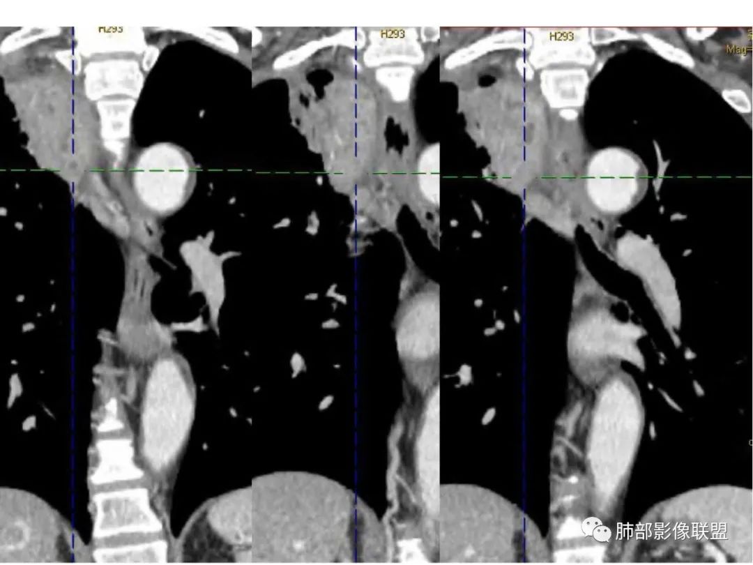 影像PPT - 【病例】肺放线菌病一例CT-15 影像PPT - 【病例】肺放线菌病一例CT-15