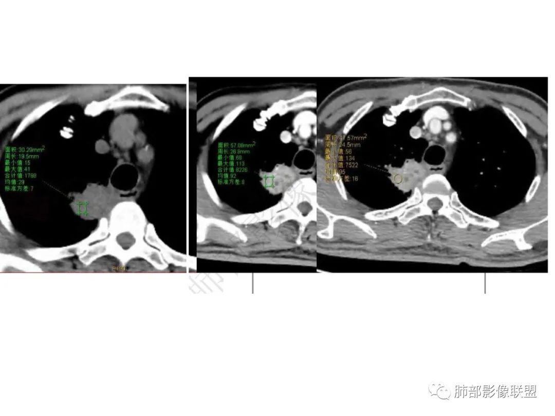 影像PPT - 【病例】肺放线菌病一例CT-17