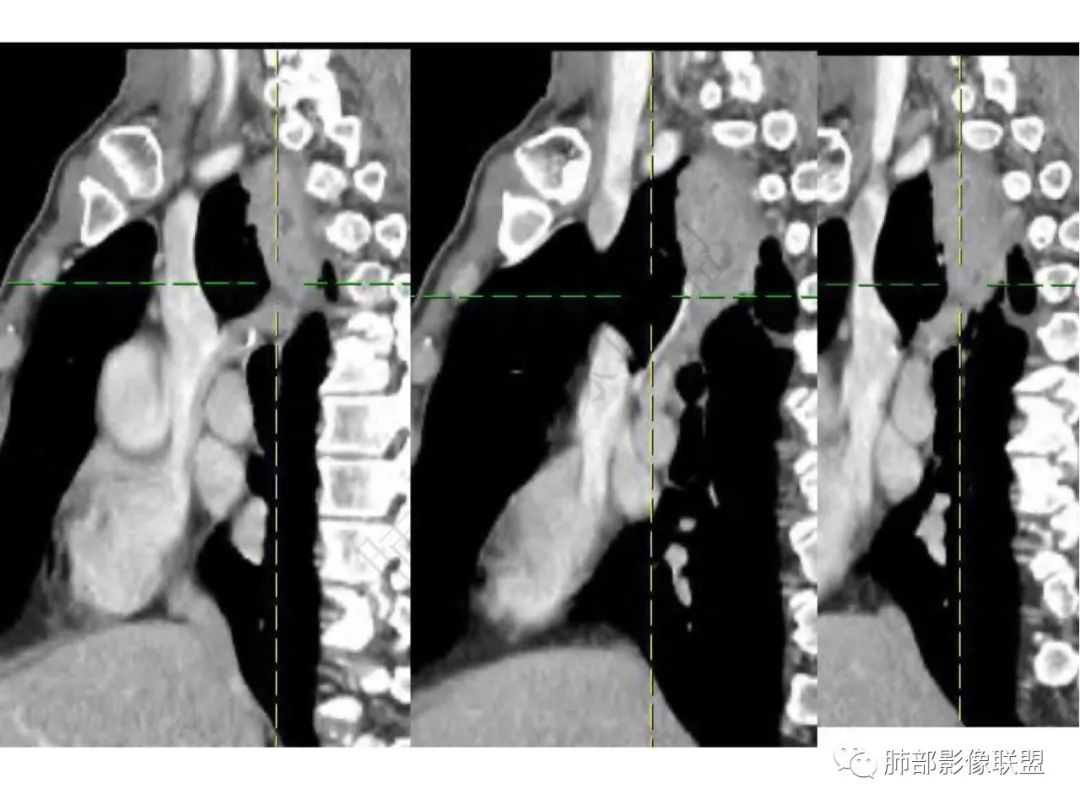 影像PPT - 【病例】肺放线菌病一例CT-16 影像PPT - 【病例】肺放线菌病一例CT-16