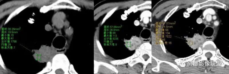 影像PPT - 【病例】肺放线菌病一例CT-27 影像PPT - 【病例】肺放线菌病一例CT-27