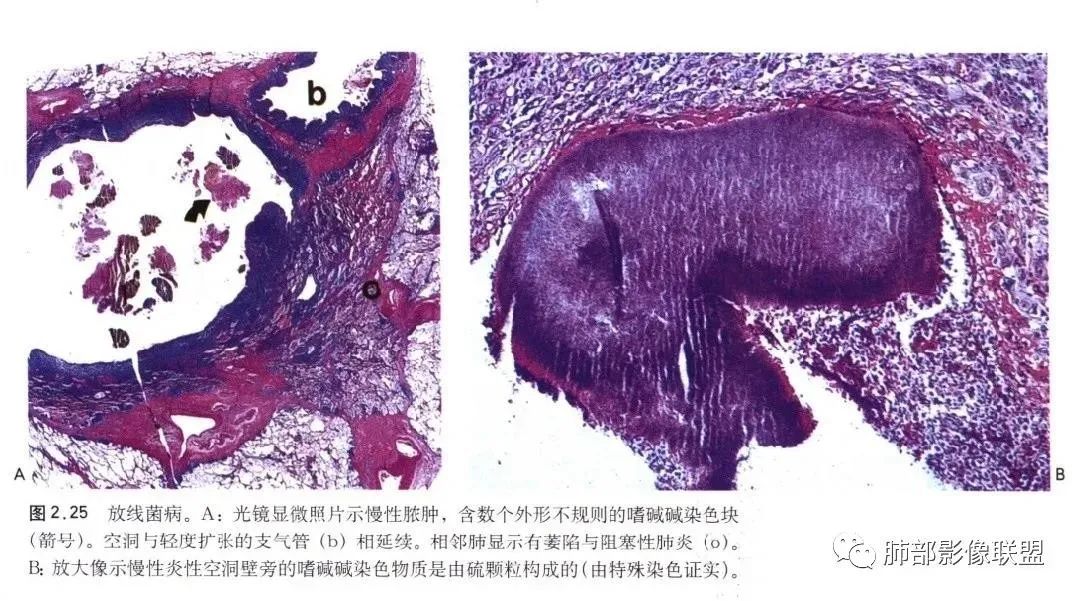 影像PPT - 【病例】肺放线菌病一例CT-35