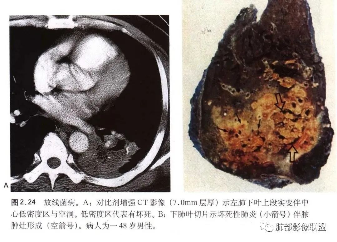 影像PPT - 【病例】肺放线菌病一例CT-38 影像PPT - 【病例】肺放线菌病一例CT-38