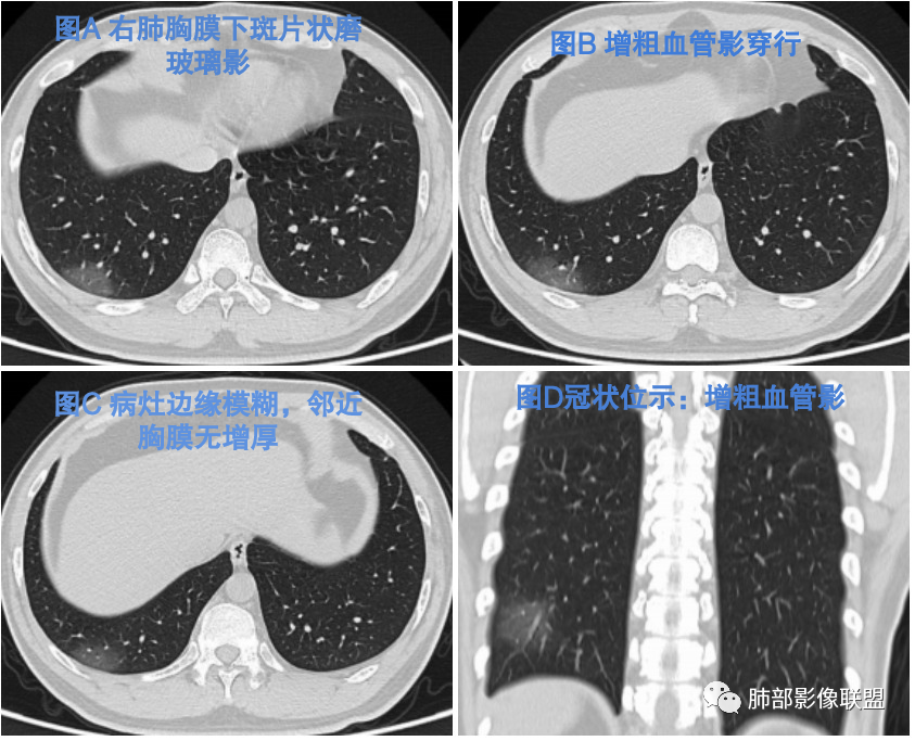 影像PPT - 【病例】新冠肺炎3例早期CT征象分析-2
