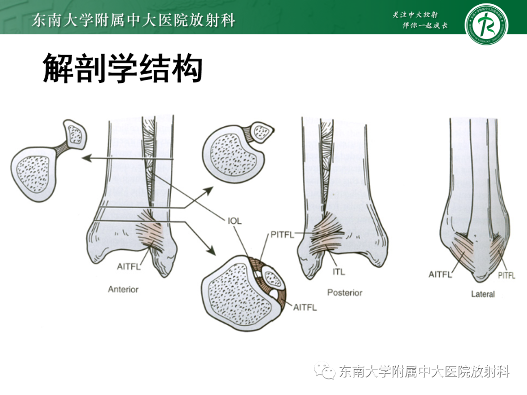 影像PPT - 【PPT】下胫腓联合损伤-10