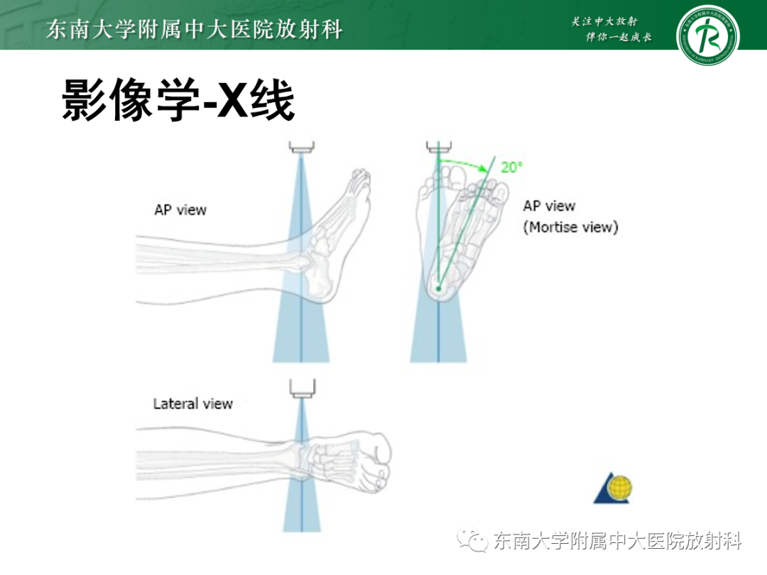 影像PPT - 【PPT】下胫腓联合损伤-15