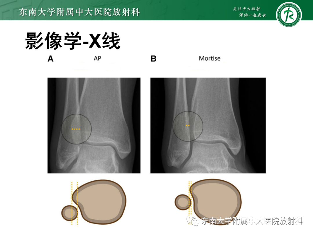 影像PPT - 【PPT】下胫腓联合损伤-16