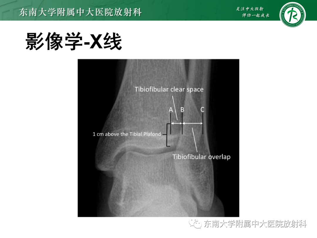 影像PPT - 【PPT】下胫腓联合损伤-17