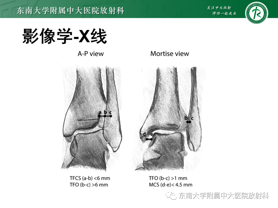 影像PPT - 【PPT】下胫腓联合损伤-18