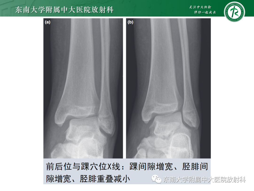 影像PPT - 【PPT】下胫腓联合损伤-20
