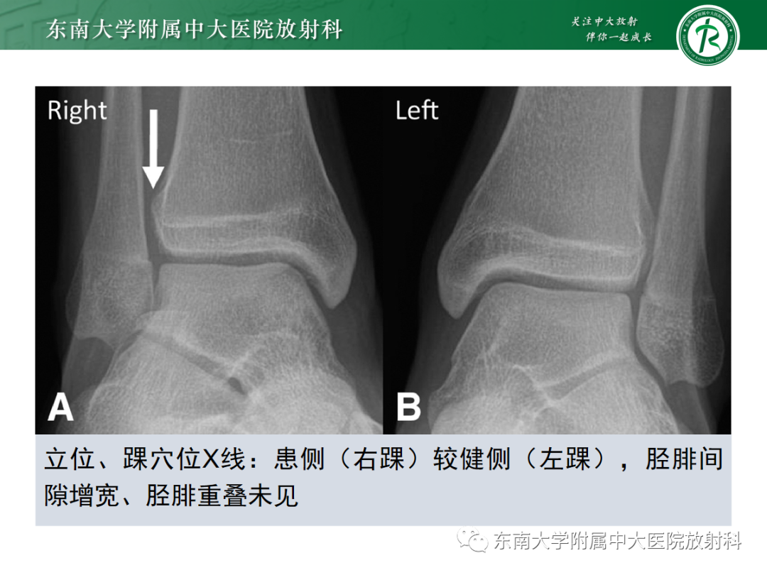影像PPT - 【PPT】下胫腓联合损伤-21