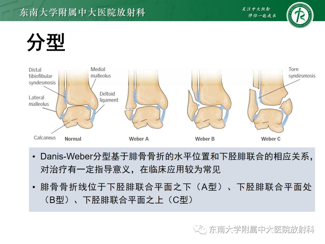 影像PPT - 【PPT】下胫腓联合损伤-23