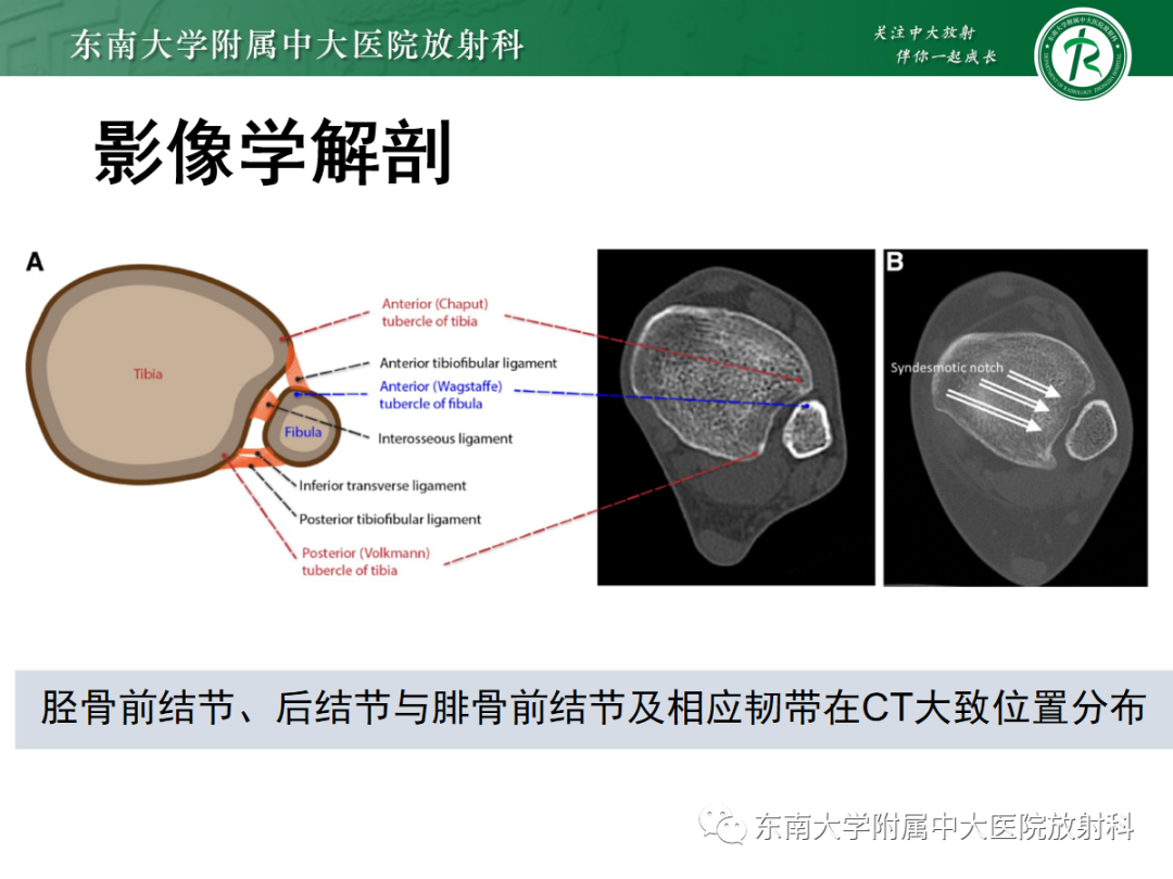 影像PPT - 【PPT】下胫腓联合损伤-25