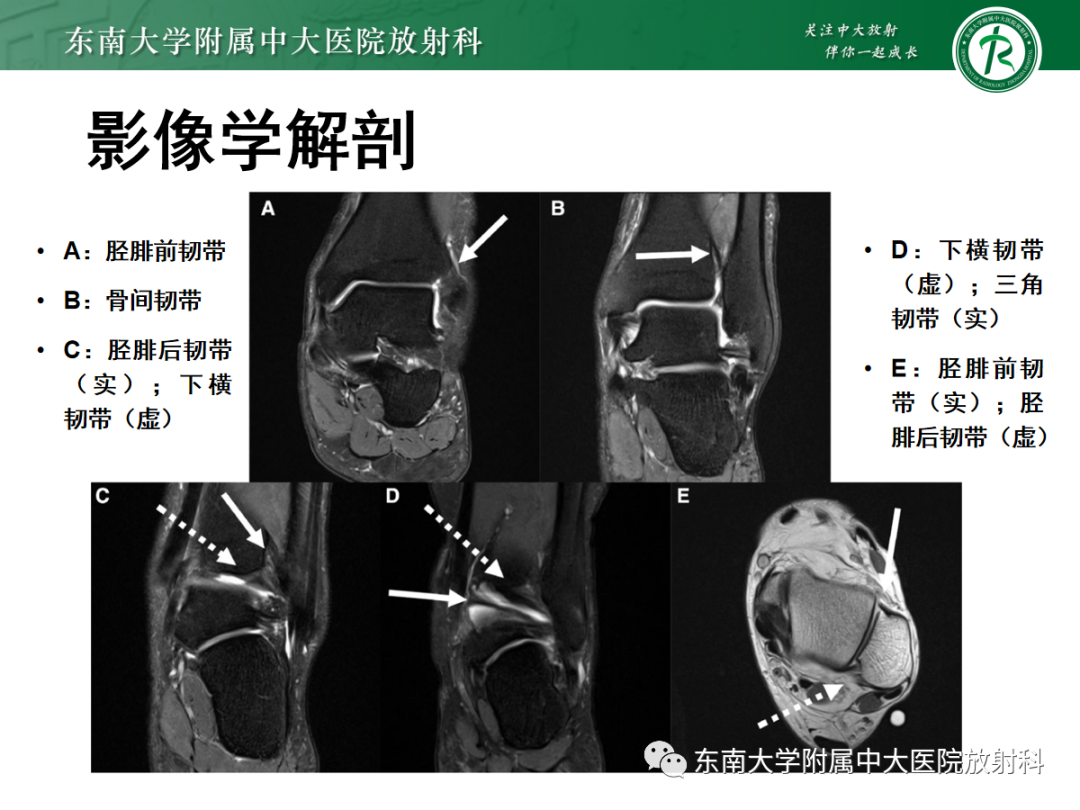 影像PPT - 【PPT】下胫腓联合损伤-26