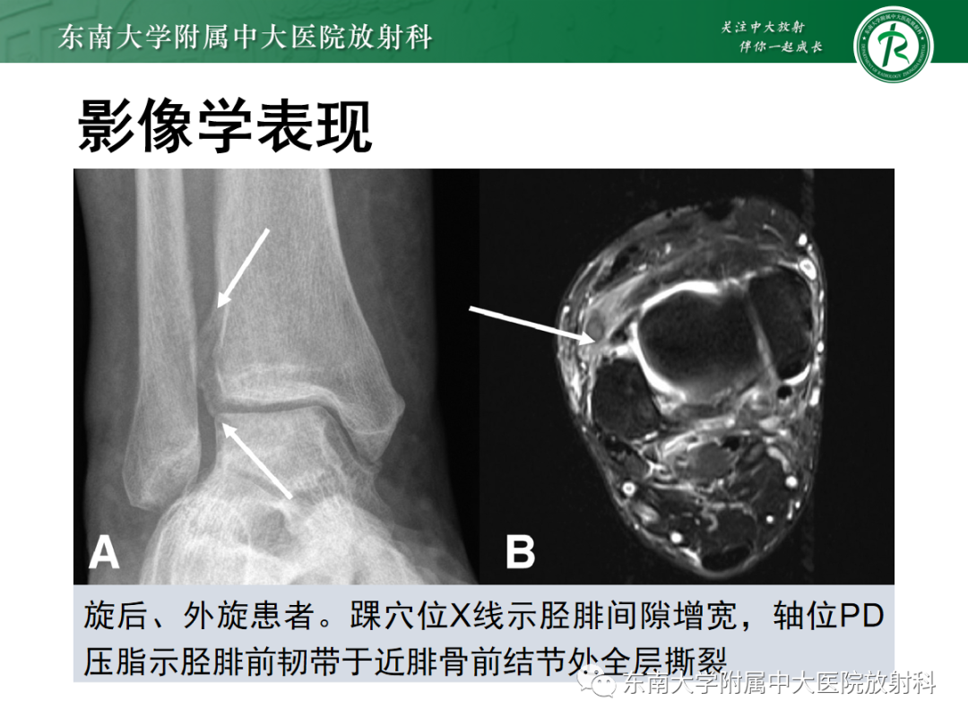 影像PPT - 【PPT】下胫腓联合损伤-28