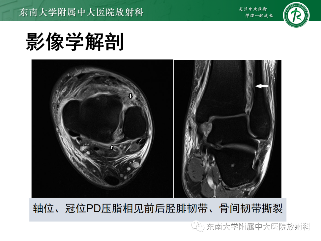 影像PPT - 【PPT】下胫腓联合损伤-27