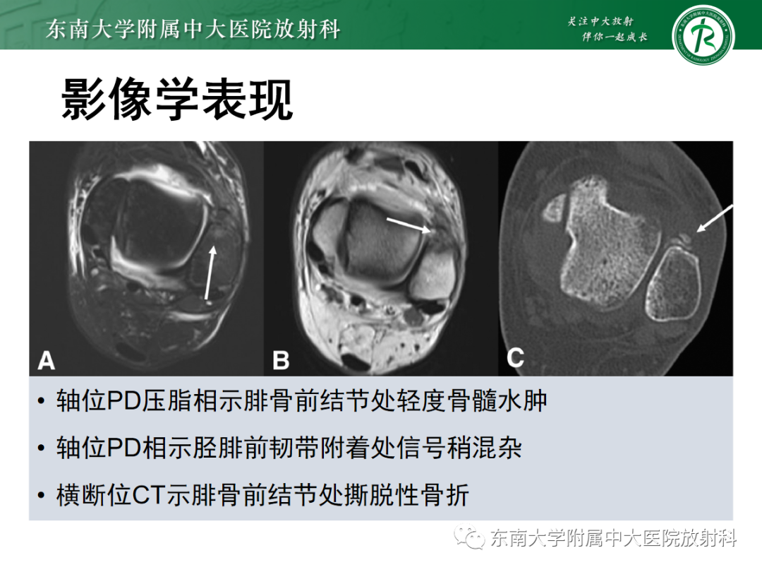 影像PPT - 【PPT】下胫腓联合损伤-29