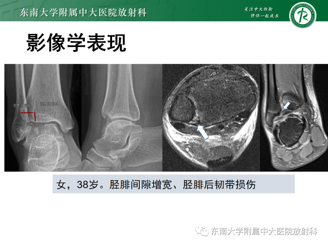 影像PPT - 【PPT】下胫腓联合损伤-30