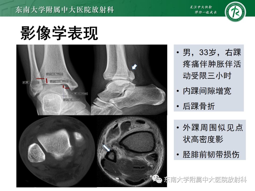 影像PPT - 【PPT】下胫腓联合损伤-31