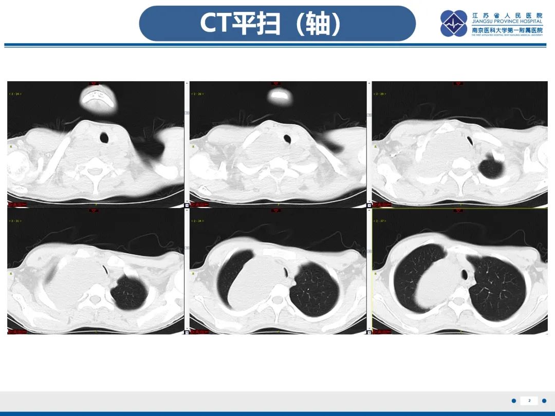 影像PPT - 【PPT】神经纤维瘤病1型-3