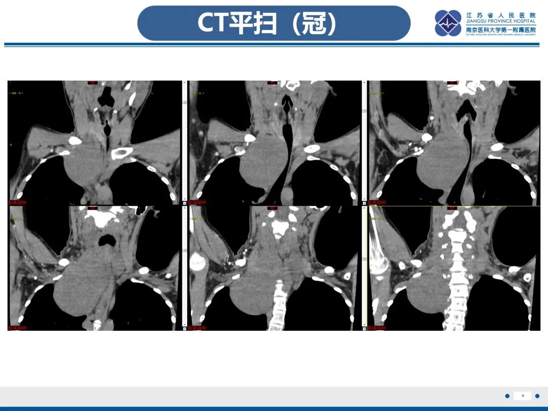 影像PPT - 【PPT】神经纤维瘤病1型-5