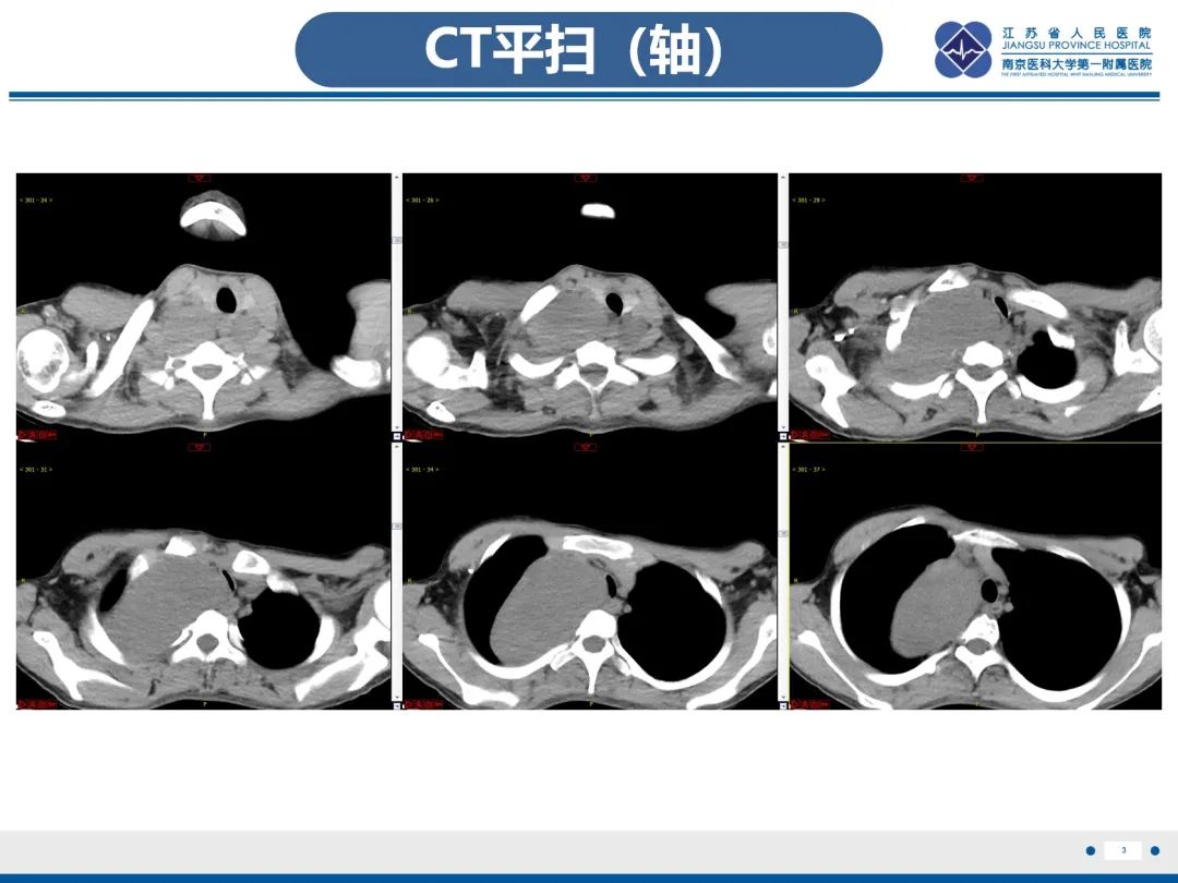 影像PPT - 【PPT】神经纤维瘤病1型-4