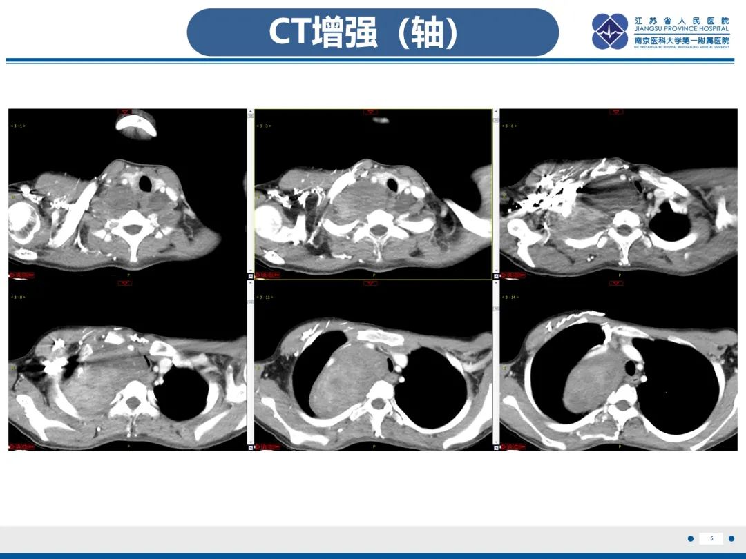 影像PPT - 【PPT】神经纤维瘤病1型-6