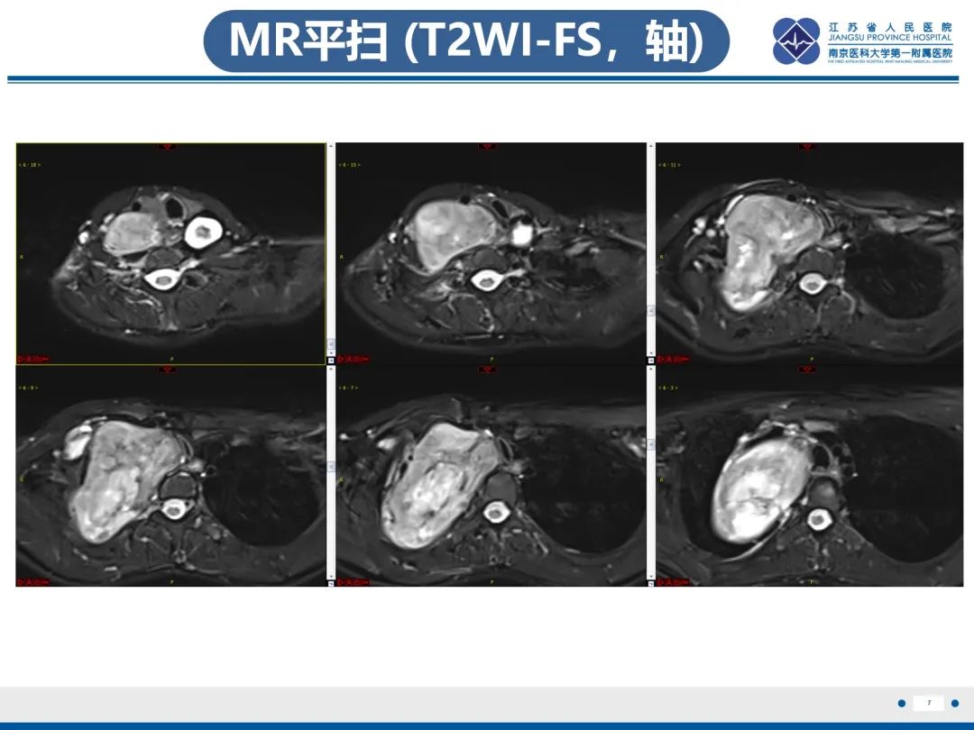 影像PPT - 【PPT】神经纤维瘤病1型-8