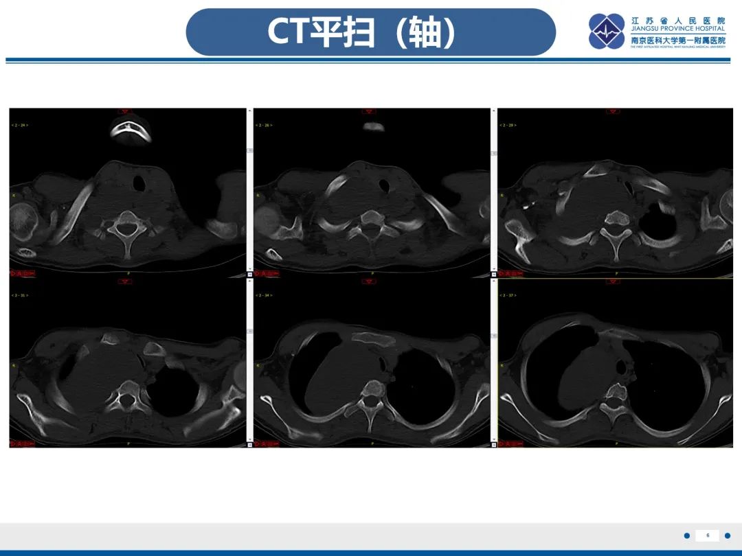 影像PPT - 【PPT】神经纤维瘤病1型-7