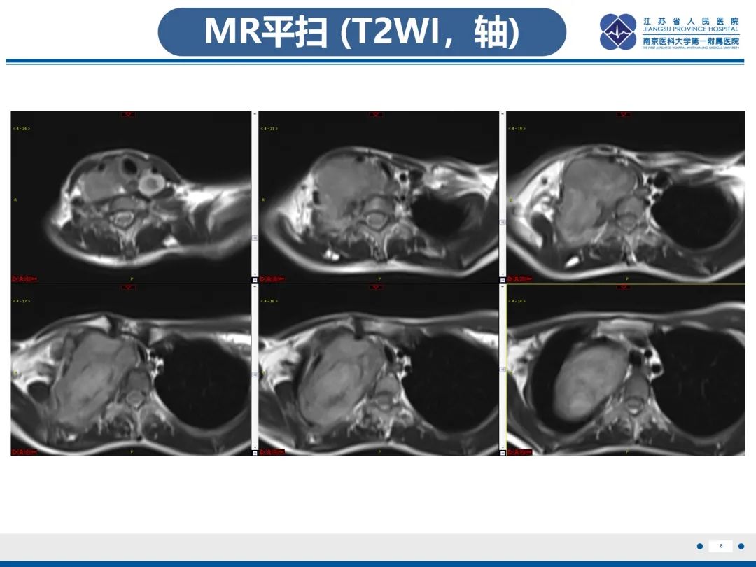 影像PPT - 【PPT】神经纤维瘤病1型-9