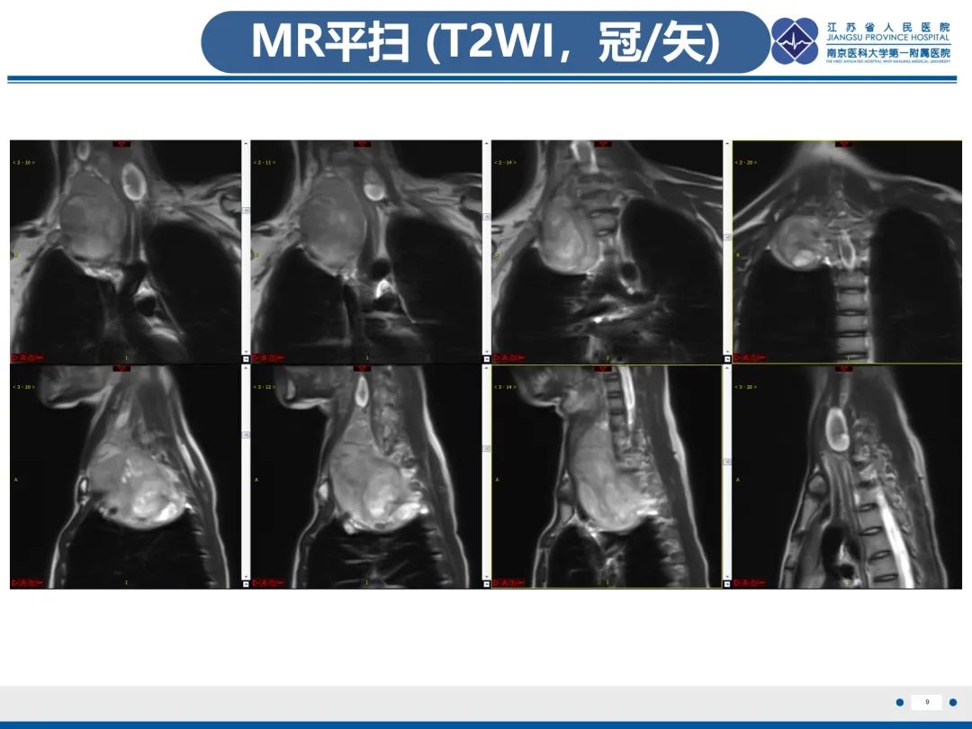 影像PPT - 【PPT】神经纤维瘤病1型-10