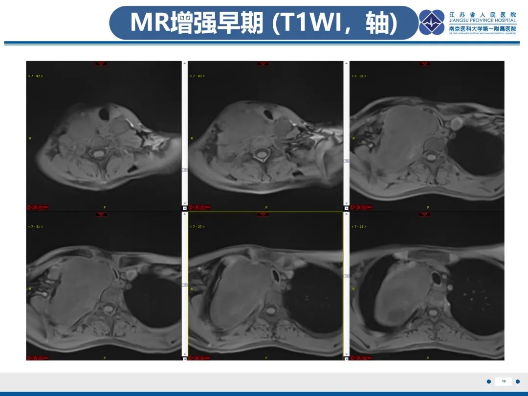 影像PPT - 【PPT】神经纤维瘤病1型-11