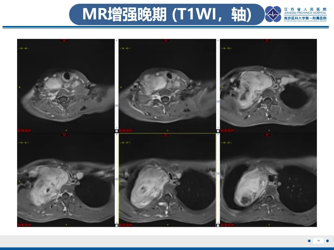 影像PPT - 【PPT】神经纤维瘤病1型-12