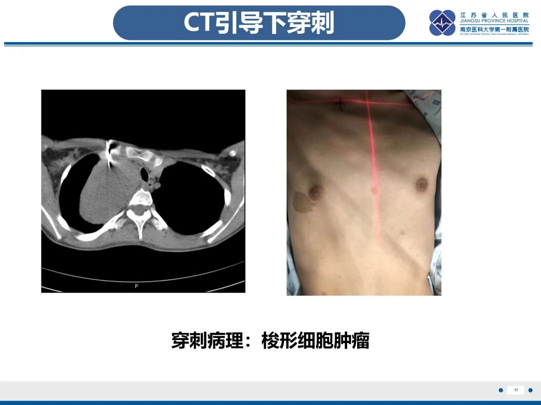 影像PPT - 【PPT】神经纤维瘤病1型-18