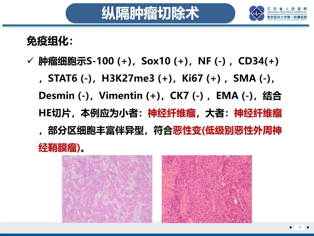 影像PPT - 【PPT】神经纤维瘤病1型-19