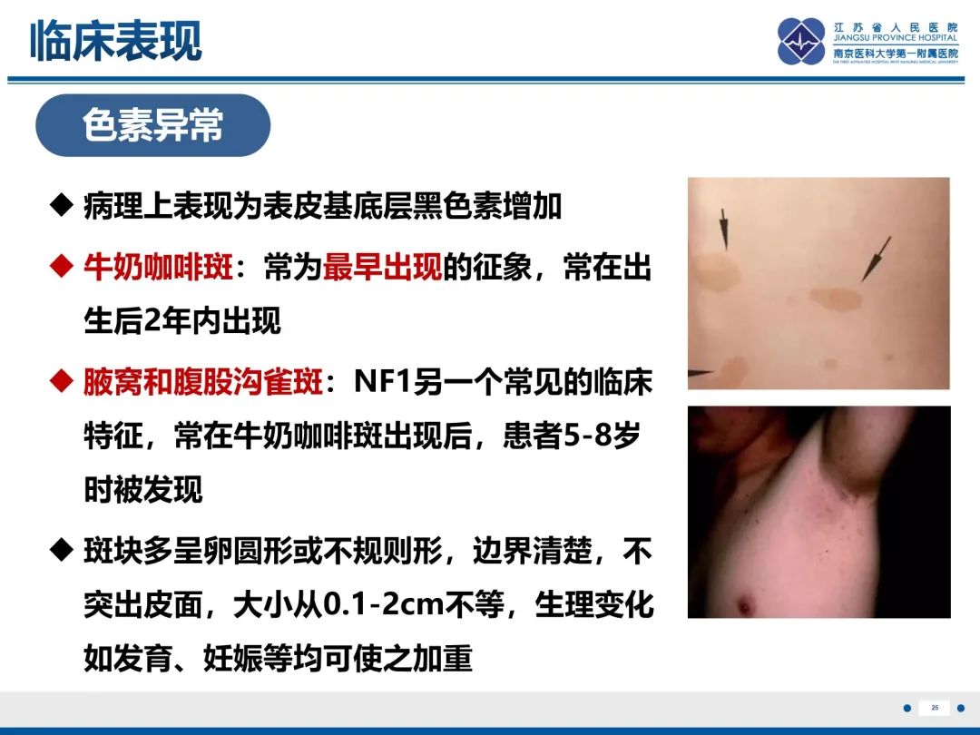 影像PPT - 【PPT】神经纤维瘤病1型-26
