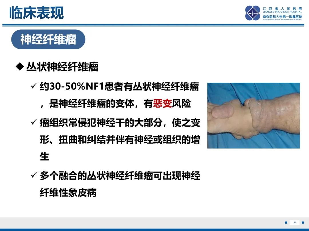 影像PPT - 【PPT】神经纤维瘤病1型-29