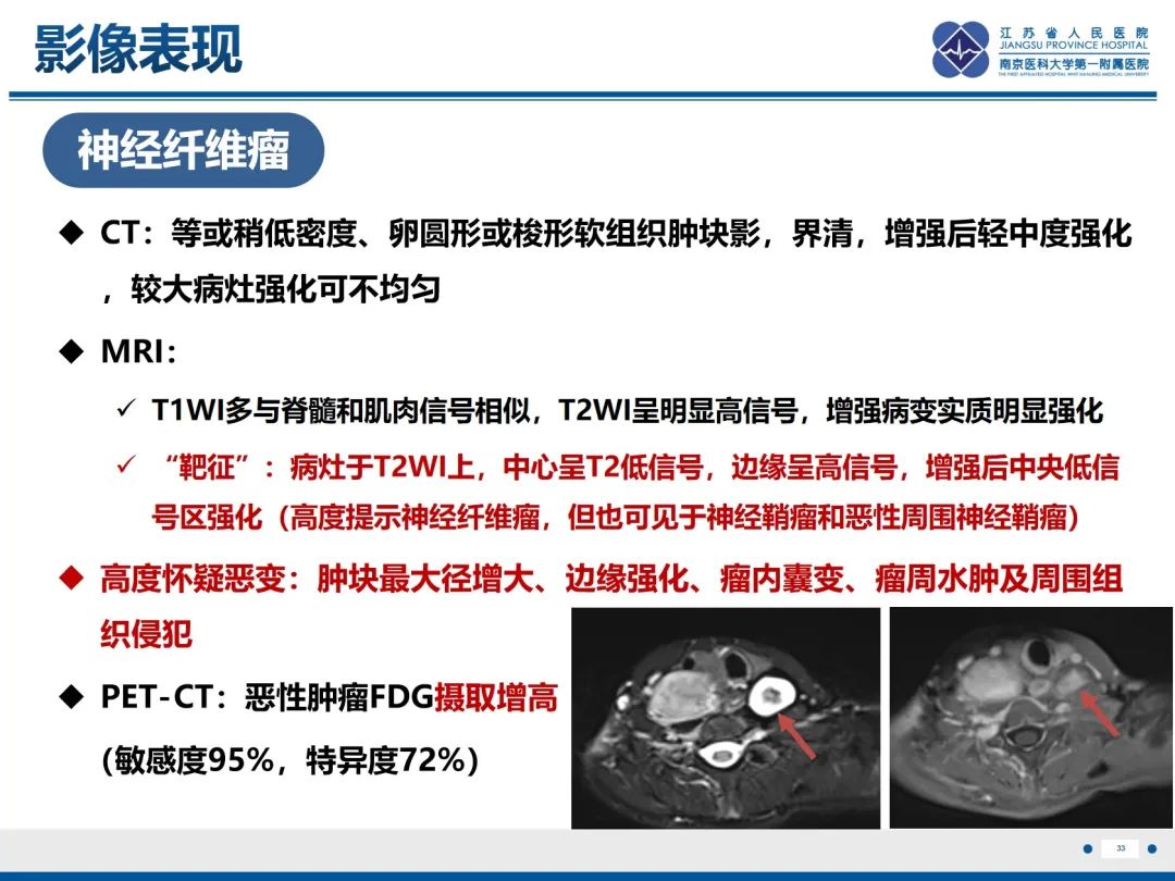 影像PPT - 【PPT】神经纤维瘤病1型-34