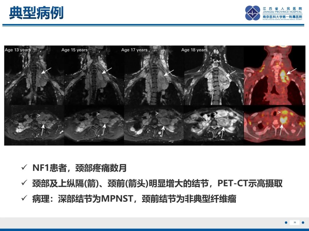 影像PPT - 【PPT】神经纤维瘤病1型-36