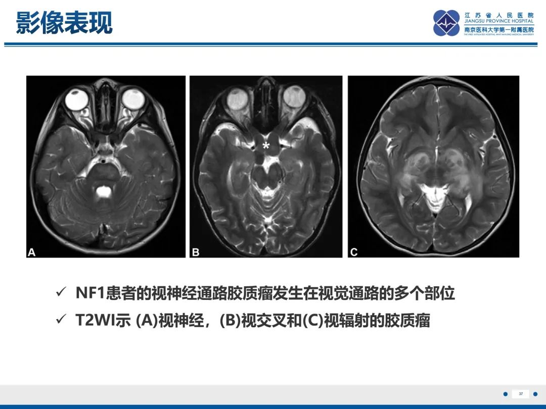 影像PPT - 【PPT】神经纤维瘤病1型-38