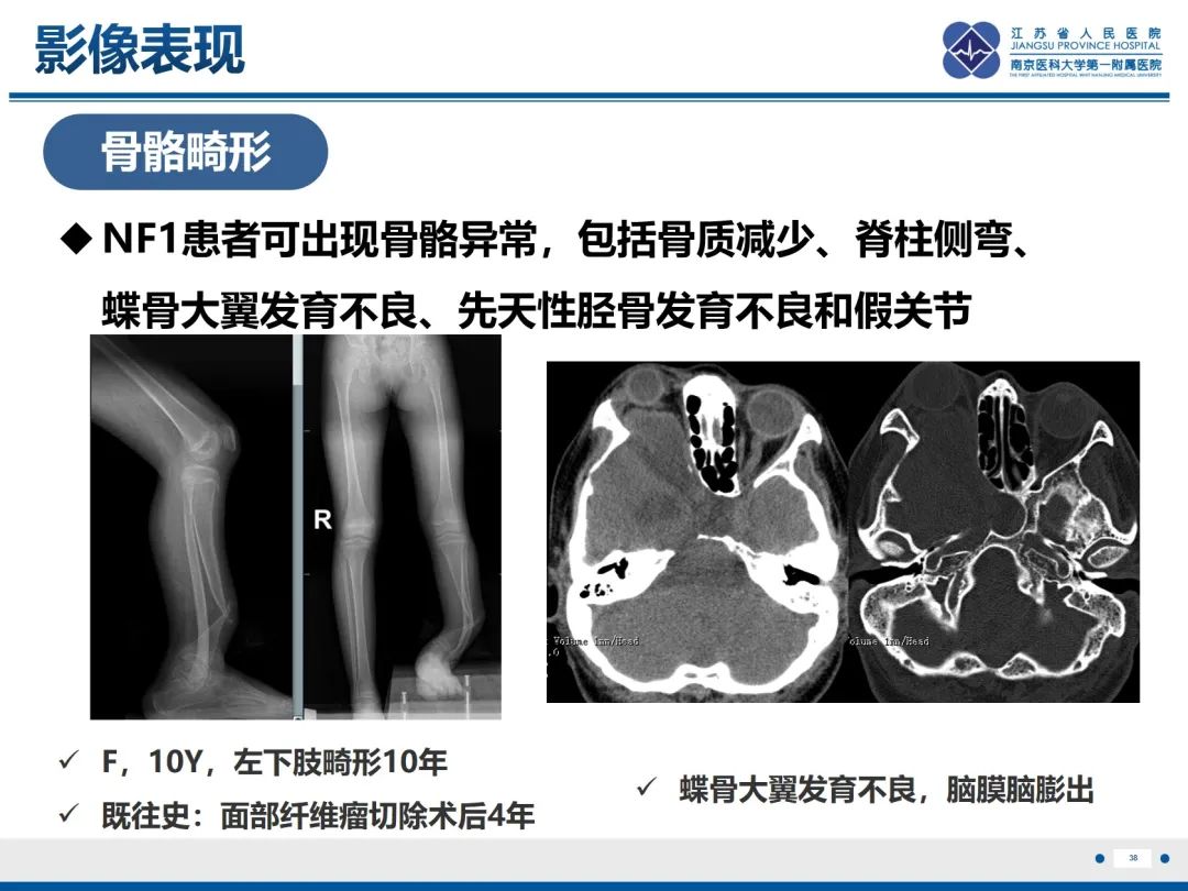 影像PPT - 【PPT】神经纤维瘤病1型-39