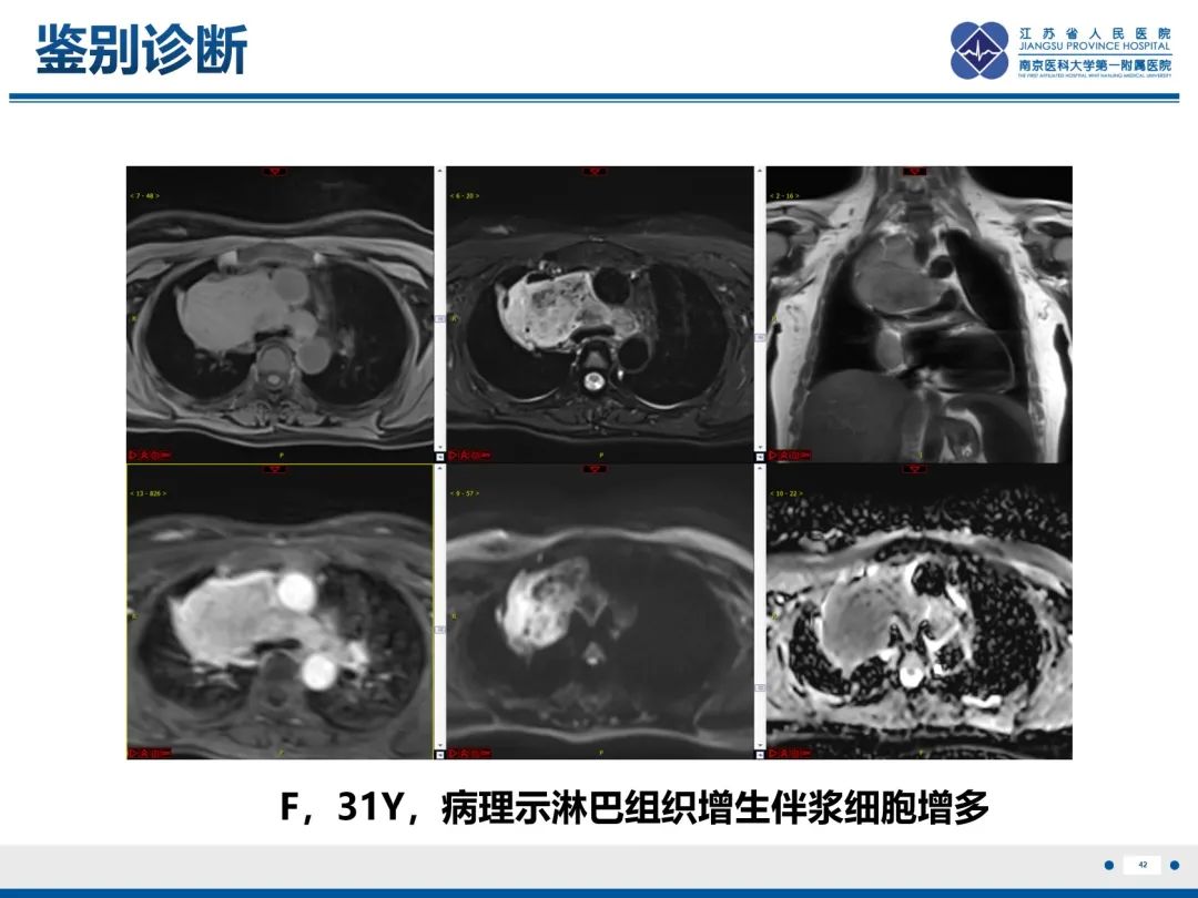 影像PPT - 【PPT】神经纤维瘤病1型-42