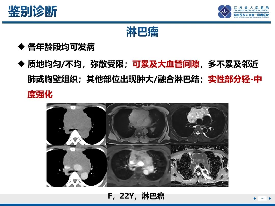 影像PPT - 【PPT】神经纤维瘤病1型-44