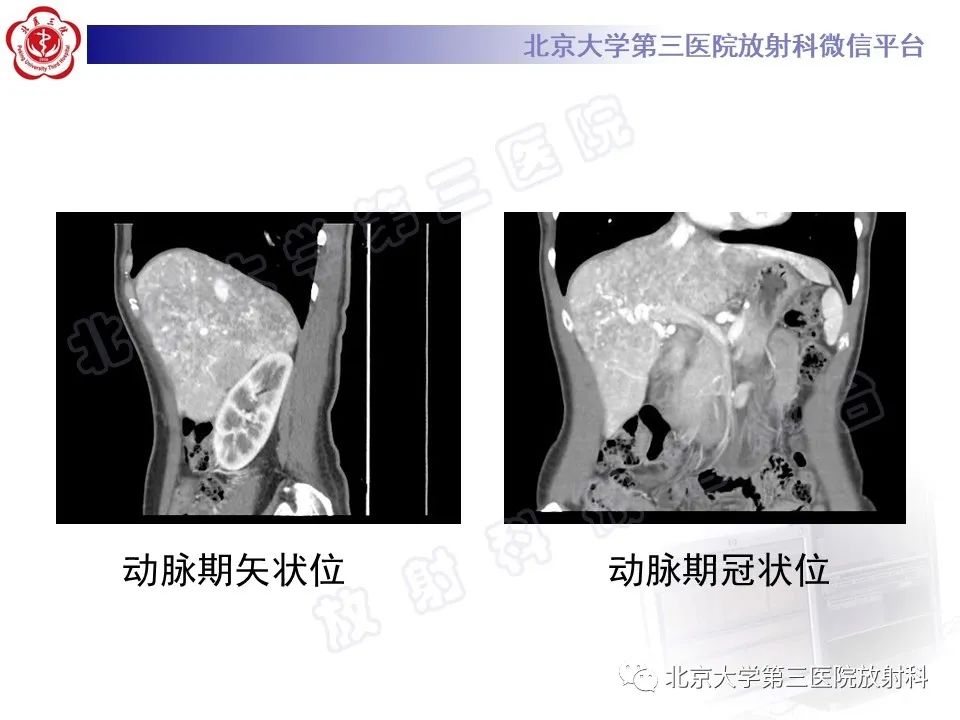 影像PPT - 【PPT】肝脏遗传性出血性毛细血管扩张症-4