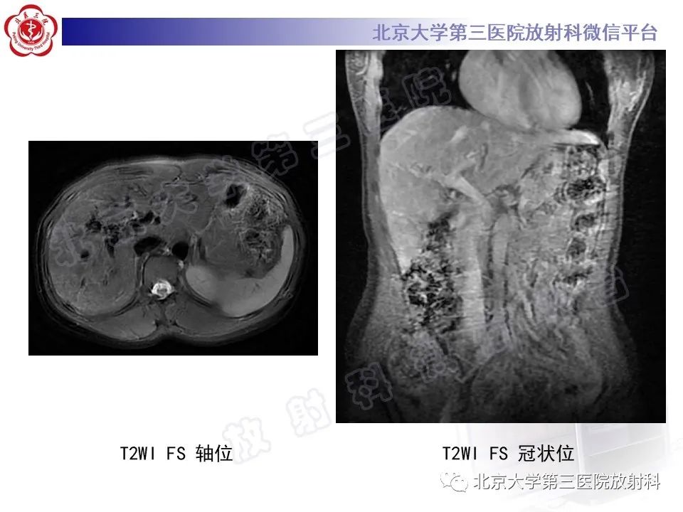 影像PPT - 【PPT】肝脏遗传性出血性毛细血管扩张症-5