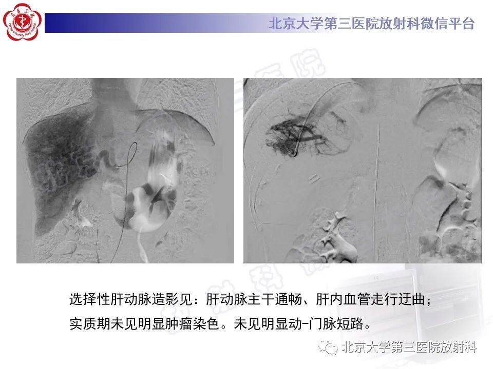 影像PPT - 【PPT】肝脏遗传性出血性毛细血管扩张症-8