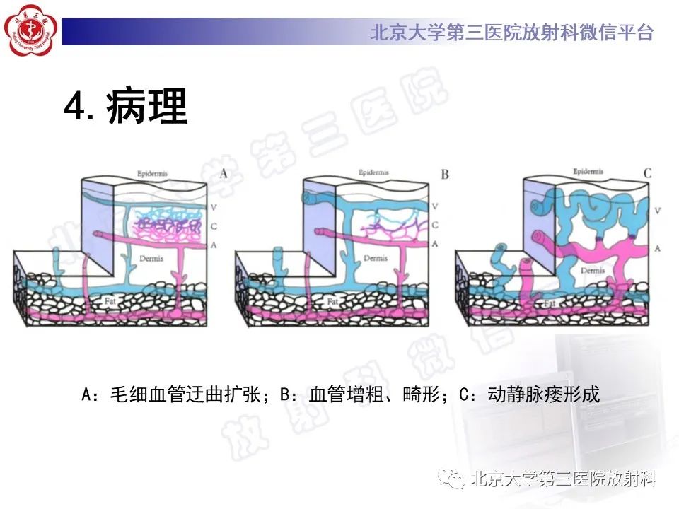 影像PPT - 【PPT】肝脏遗传性出血性毛细血管扩张症-16